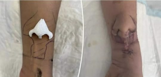 …जब हाथ में बनाना पड़ा नाक